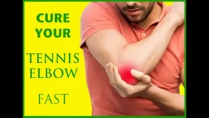 How to Heal Tennis Elbow: A Complete GuideTennis elbow can be a real pain – literally! Caused by repetitive stress, this condition isn’t just a problem for athletes; anyone can develop it. Knowing how to heal tennis elbow can help you get back to your regular activities without the lingering ache. This guide covers everything you need to know about relieving and healing tennis elbow, from at-home remedies to professional treatments. Let’s dive in and take a closer look at how you can make that pain a thing of the past.
What is Tennis Elbow?
Tennis elbow, or lateral epicondylitis, is a painful condition where the outer elbow becomes inflamed. This inflammation affects the tendons that connect your forearm muscles to the bony part of your elbow, leading to soreness and tenderness that can disrupt everyday activities.
What Causes Tennis Elbow?
Most cases of tennis elbow result from repetitive motions, such as gripping or lifting. This puts excessive strain on the elbow tendons, leading to small tears and inflammation. Risk factors include engaging in activities that require repetitive arm movements, like tennis (hence the name!), painting, or even typing.
How to Know if You Have Tennis Elbow
If you’re dealing with persistent pain in your elbow or forearm, especially when lifting or gripping objects, you might be facing tennis elbow. Other telltale signs include pain that radiates down your forearm and worsens with certain wrist movements.
Why Tennis Elbow Needs Proper Care
Left untreated, tennis elbow can lead to weakened forearm muscles and a limited range of motion. Ignoring the pain may cause it to become chronic, making recovery a longer and more challenging process. Proper care ensures you avoid these complications.
Immediate Remedies for Tennis Elbow Pain
Start with these quick fixes to help ease the pain:
Ice Packs: Apply ice for 15-20 minutes several times daily to reduce inflammation.
Rest: Avoid activities that exacerbate pain to give your elbow a chance to heal.
Anti-inflammatory Medication: Over-the-counter options can help reduce pain and swelling.
Home Treatments for How to Heal Tennis Elbow
For those dealing with mild pain, home remedies can be highly effective:
Gentle Stretches: Start with gentle forearm stretches to improve flexibility.
Compression: Using a compression band can support the injured area and reduce strain.
Support Techniques: Try to use proper techniques when lifting or carrying objects.
Exercises to Strengthen and Heal Tennis Elbow
Strengthening exercises are crucial for long-term recovery:
Forearm Stretches: Stretch your forearm by extending your arm and pulling your fingers back gently.
Wrist Flexor Exercises: Hold a light weight in your hand, palm facing up, and slowly lift and lower it.
Wrist Extensor Exercises: With your palm facing down, lift and lower the weight to work your forearm extensors.
Lifestyle Adjustments to Prevent Tennis Elbow Recurrence
Preventing a tennis elbow flare-up means making a few lifestyle changes:
Ergonomics: Ensure your workspace is set up to minimize strain on your arms.
Proper Lifting Techniques: Avoid heavy lifting with poor form, which can increase stress on your elbow.
Activity Modification: Avoid repetitive motions when possible, or take breaks to relieve stress on your elbow.
Professional Treatments for Advanced Cases
If home remedies aren’t enough, professional treatments may help:
Physical Therapy: A therapist can guide you through specific exercises to strengthen your elbow.
Cortisone Injections: These can provide temporary pain relief for severe cases.
Surgical Options: Surgery is rarely necessary, but it may be recommended in chronic, resistant cases.
When to See a Doctor
If your symptoms persist despite at-home treatments, it’s time to see a doctor. You should also seek professional help if you experience severe pain, swelling, or loss of motion, as these can indicate a more serious injury.
Alternative Therapies for Tennis Elbow Relief
Some alternative treatments have shown promise for tennis elbow pain:
Acupuncture: This ancient practice may reduce inflammation and provide pain relief.
Massage Therapy: Deep tissue massage around the elbow can improve blood flow and reduce stiffness.
Heat Therapy: Applying heat can ease muscle tightness around the affected area.
Ultrasound Treatment: This therapy uses sound waves to increase blood flow and promote healing.
Using Braces and Supports for Tennis Elbow
Braces can be a game-changer in healing tennis elbow. Look for a brace that provides targeted compression to the forearm muscles and reduces strain on the elbow tendons.
Nutrition Tips to Support Healing
What you eat matters when it comes to healing:
Anti-inflammatory Foods: Incorporate foods like turmeric, ginger, and omega-3-rich fish to reduce inflammation.
Vitamins and Minerals: Ensure you’re getting enough vitamins C and D, as well as zinc and magnesium, which play a role in tissue repair.
FAQs
Can tennis elbow go away on its own?
Mild cases may resolve with rest, but for faster relief and full recovery, a proactive treatment approach is best.
How long does it take to heal tennis elbow?
Recovery time varies, but with proper care, most cases improve within 6-12 weeks.
Is massage good for tennis elbow?
Yes, massage can improve circulation and relieve tension, aiding recovery.
What’s the best brace for tennis elbow?
Look for a brace that offers compression and support without limiting movement.
Should I stop all activities if I have tennis elbow?
You don’t need to stop completely, but avoiding activities that cause pain is essential for healing.
Conclusion
Healing tennis elbow takes time, patience, and consistency. By combining at-home remedies, exercises, and possibly professional guidance, you can reduce pain, build strength, and prevent a recurrence. Remember, taking care of your elbow today means a pain-free tomorrow.